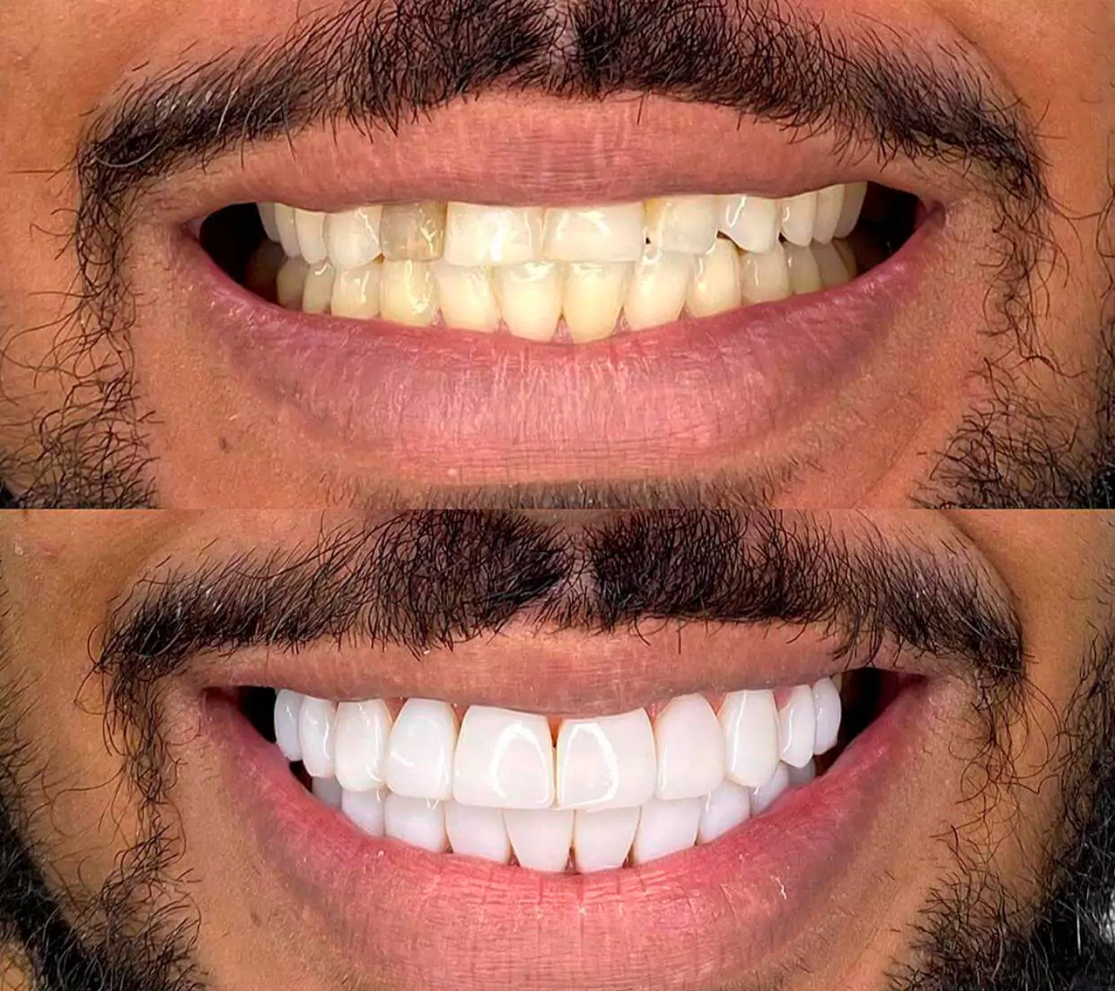 Antes e depois do tratamento Facetas em resinas