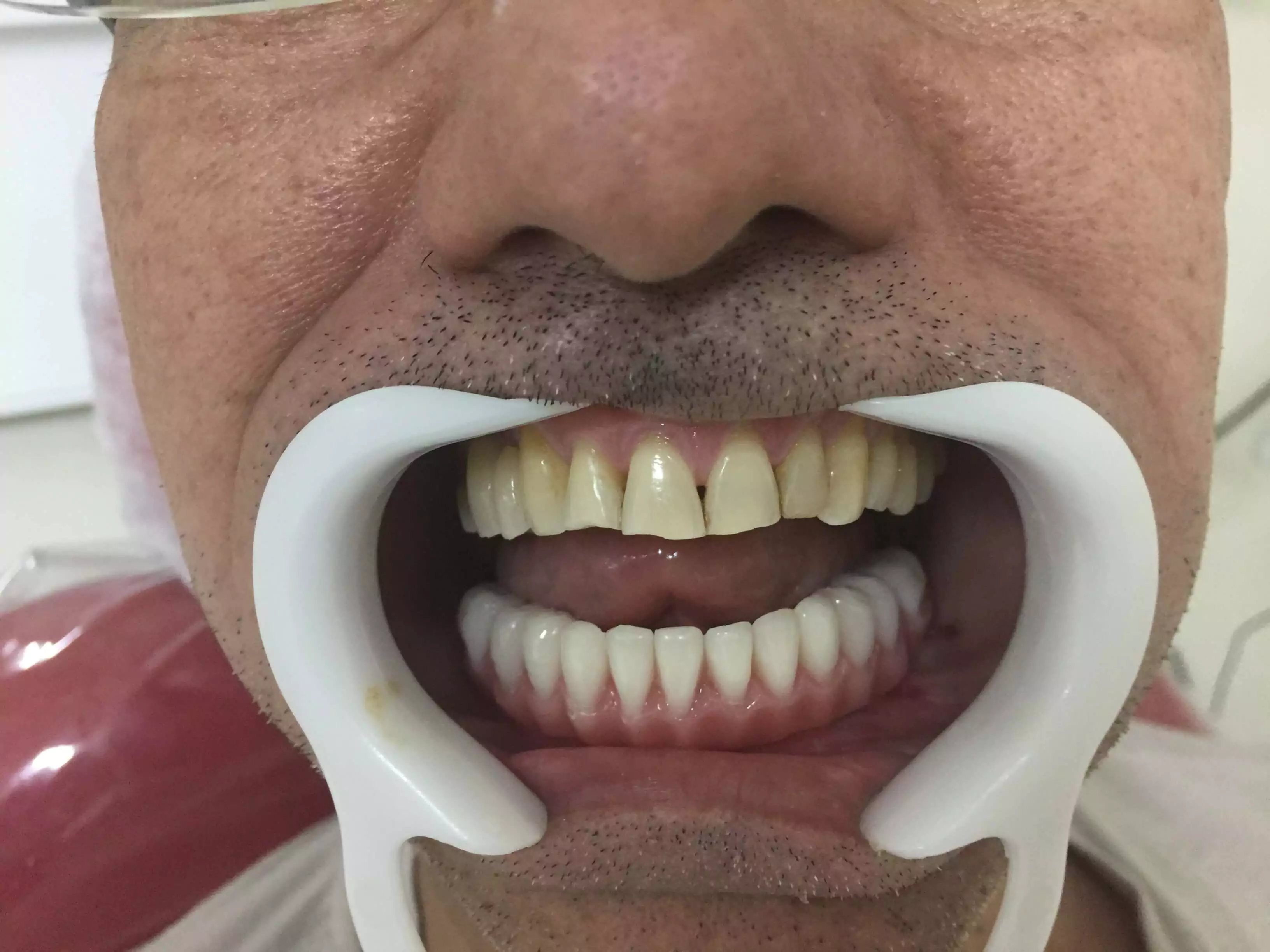 Antes e depois do implante dentário