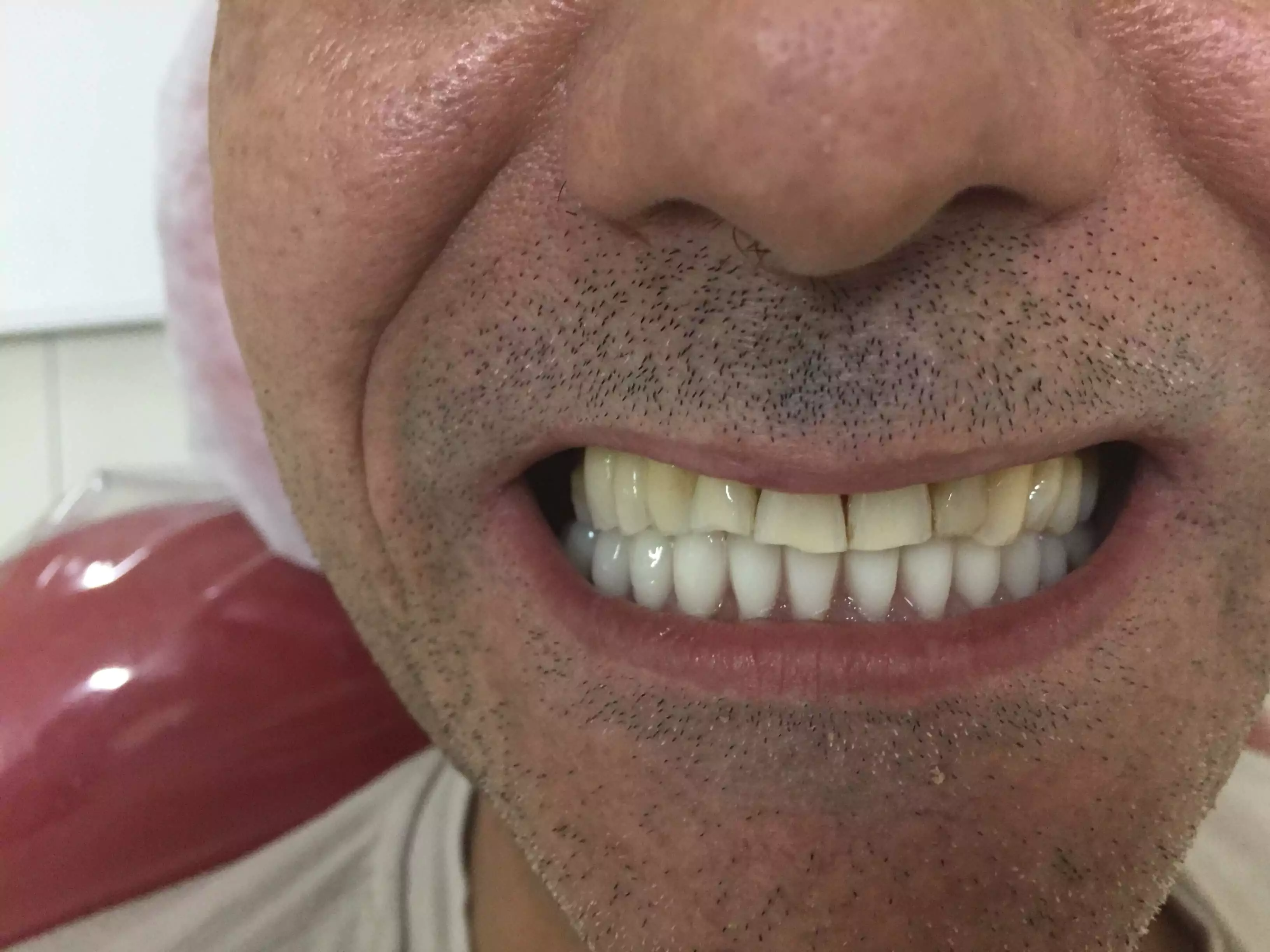 Antes e depois do implante dentário