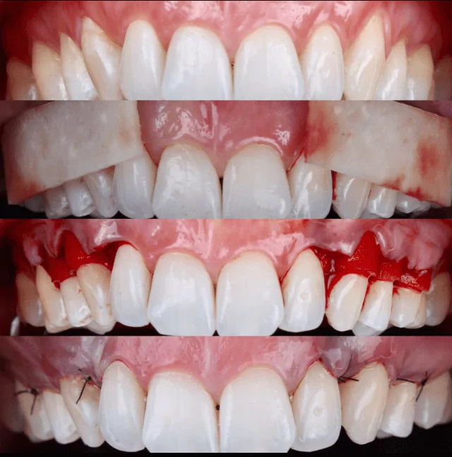 Antes e depois da Periodontia