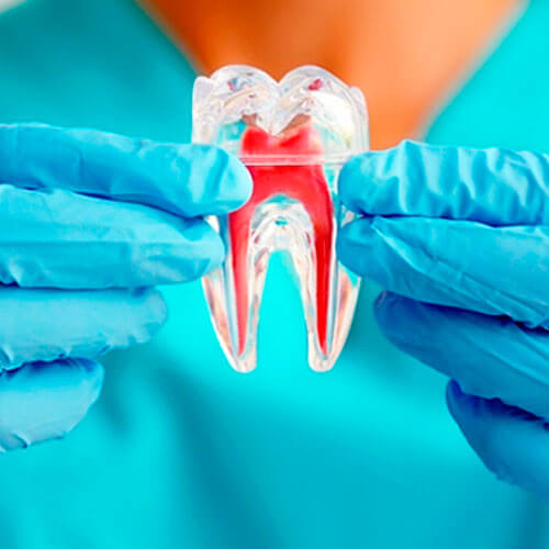 Endodontia em clínica odontológica em Guarulhos