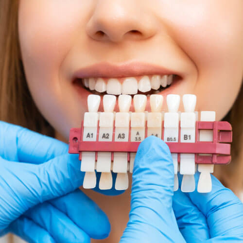 Conjunto de implantes com vários tons de factas de resina e sorriso perfeito de mulher na clínica odontológica em Guarulhos