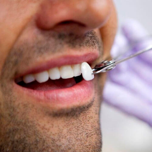 Lente de contato dental em clínica odontológica em Guarulhos