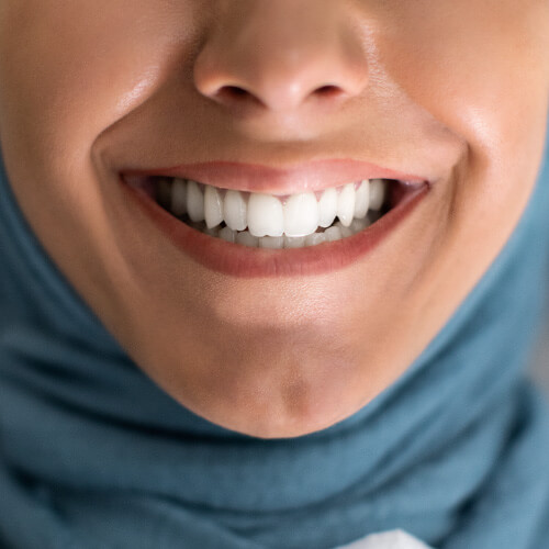 Paciente colocando lentes de contato dental na clínica odontológica em Guarulhos