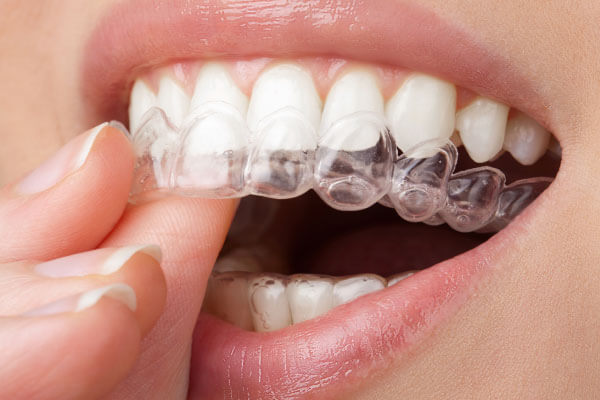 Mulher segurando aparelho invisalign sorrindo