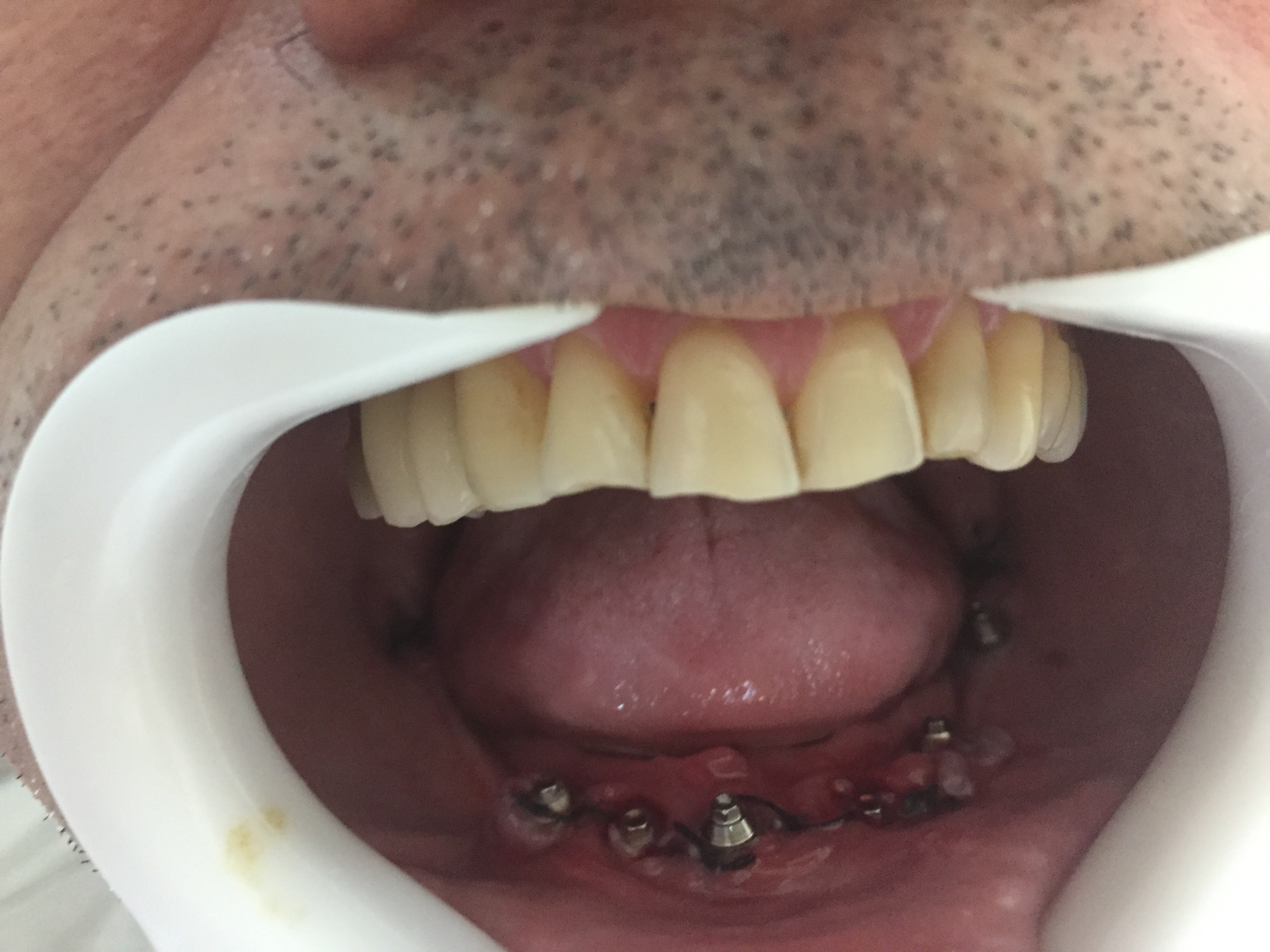 implantes dentÃ¡rios em guarulhos